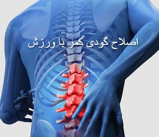 اصلاح گودی کمر با ورزش